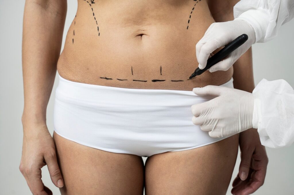 Abdominoplasty vs Liposuction