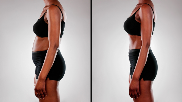 Abdominoplasty before and after gallery