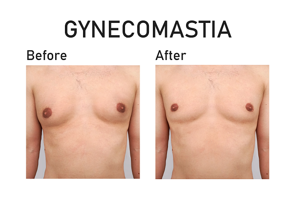 Gynecomastia Plastic Surgery Before After