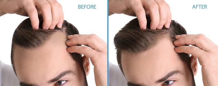 before and after hair transplant 