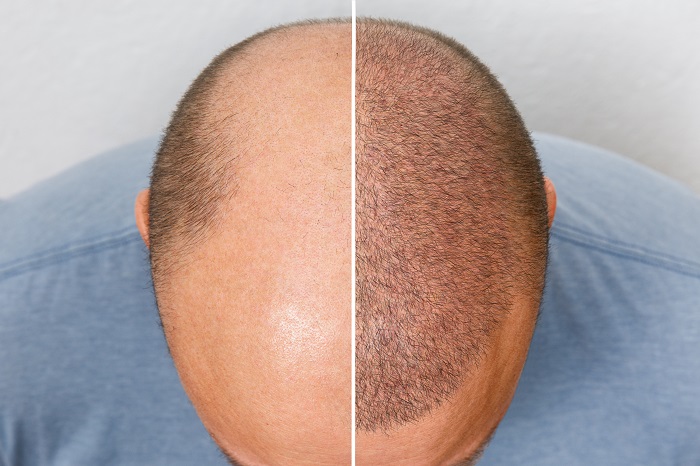 before and after hair transplant 