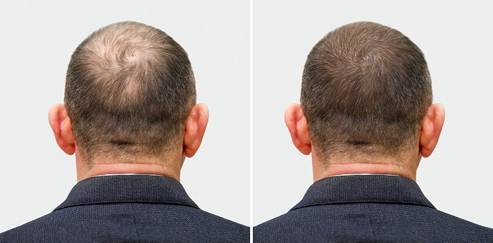 hair transplant
